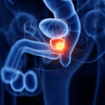 Příznaky rakoviny prostaty a její léčba